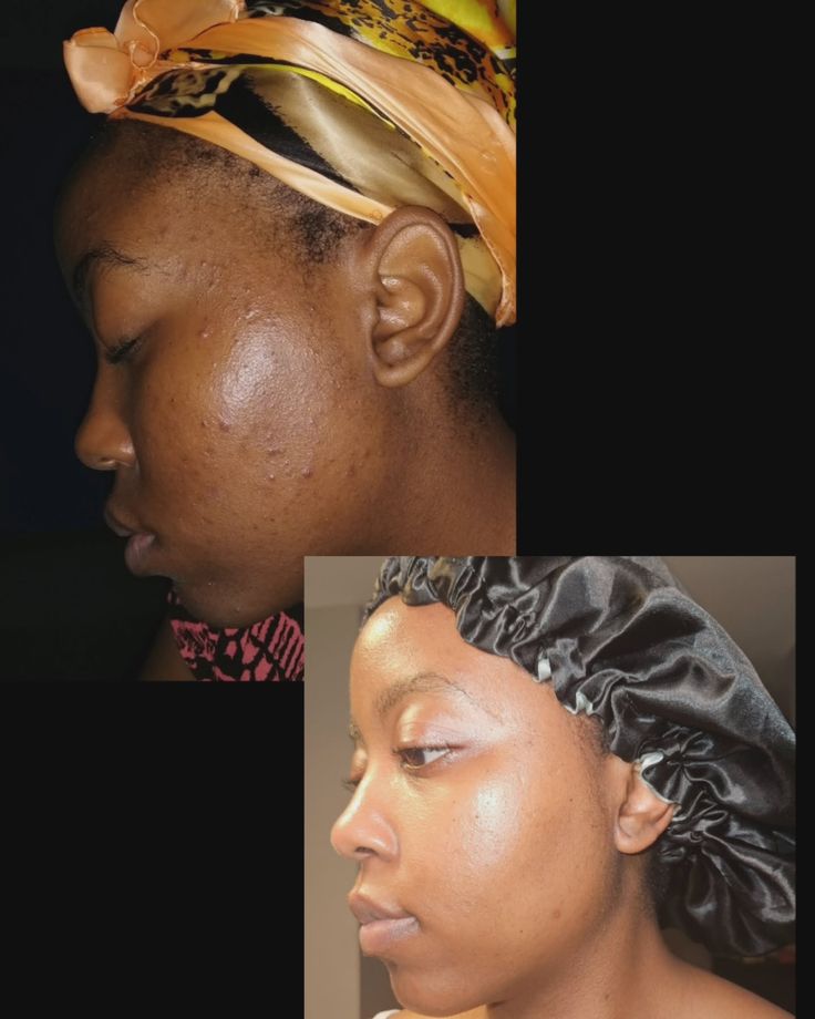 Savon Kojie San : Éclat Naturel, Peau Nette, Fraîche & Éclatante